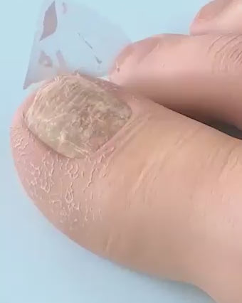 NailFix Pro - Parches para hongos en uñas de pies - 21 parches